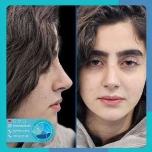 عمل-بینی-44