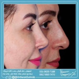 rhinoplasty-59