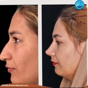 rhinoplasty-67
