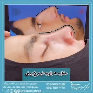 rhinoplasty-70