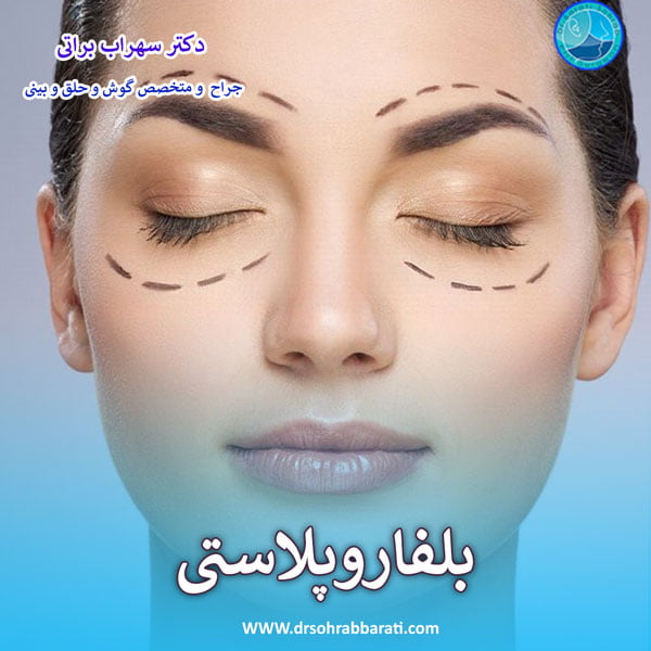 بلفاروپلاستی پلک بالا و پایین - دکتر سهراب براتی