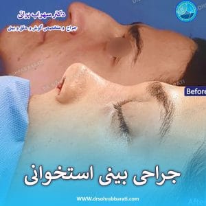 جراحی بینی استخوانی - دکتر سهراب براتی