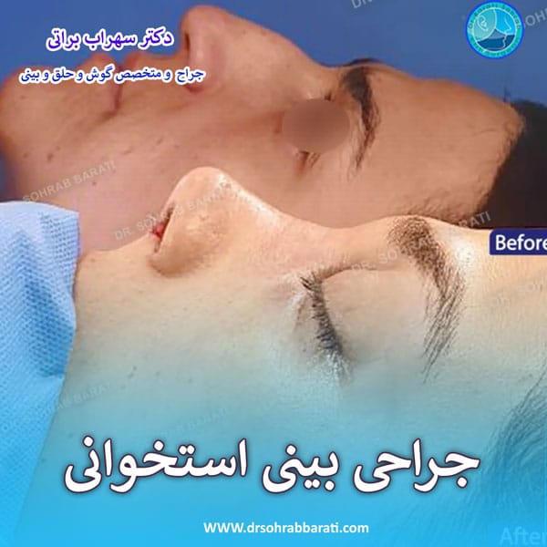 جراحی بینی استخوانی در اصفهان - دکتر سهراب براتی