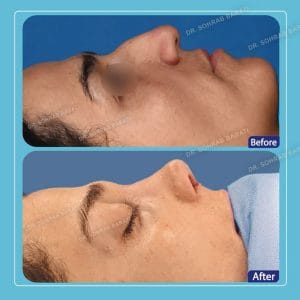 عمل بینی استخوانی در اصفهان - دکتر سهراب براتی