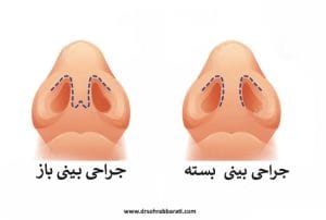 جراحی بینی به روش باز و بسته - دکتر سهراب براتی