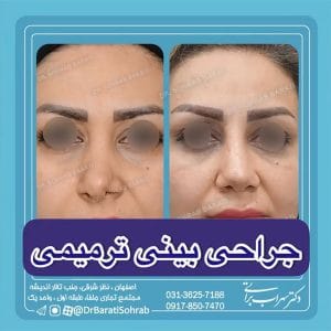 جراحی بینی ترمیمی در اصفهان _ دکتر سهراب براتی