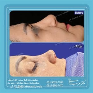 عمل بینی ترمیمی در اصفهان _ دکتر سهراب براتی