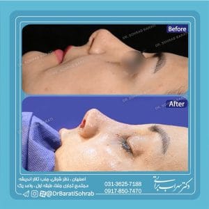 جراحی بینی ترمیمی در اصفهان ، دکتر سهراب براتی