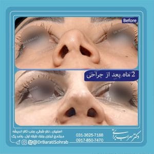 جراحی بینی ترمیمی در اصفهان _ دکتر سهراب براتی