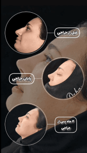 عکس نمونه کار جراح بینی در اصفهان - دکتر براتی -/drsohrabbarati.com
