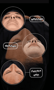 عکس نمونه کار دکتر جراح بینی اصفهان - دکتر براتی -drsohrabbarati.com