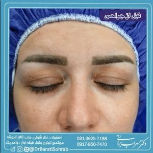 جراحی بلفاروپلاستی در اصفهان - دکتر سهراب براتی