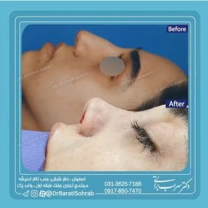 عکس نمونه کار بهترین جراح بینی استخوانی اصفهان _ دکتر سهراب براتی-drsohrabbarati.com
