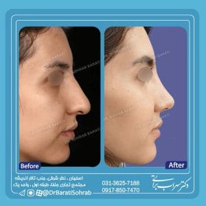 عکس نمونه کار بهترین جراح بینی گوشتی در اصفهان - دکتر سهراب براتی-drsohrabbarati.com