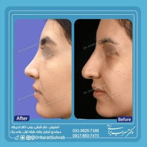 عکس نمونه عمل بهترین جراح بینی گوشتی در اصفهان - دکتر سهراب براتی-drsohrabbarati.com