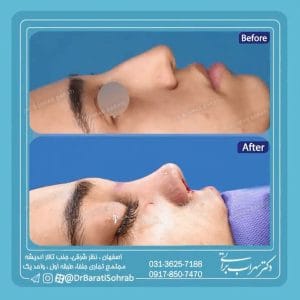 نمونه کار بهترین جراح بینی اصفهان - دکتر سهراب براتی-drsohrabbarati.com