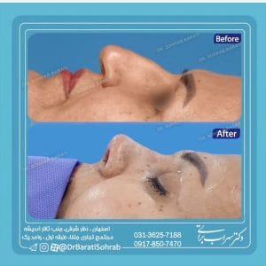 نمونه جراحی از بهترین جراح بینی طبیعی در اصفهان _ دکتر سهراب براتی-drsohrabbarati.com