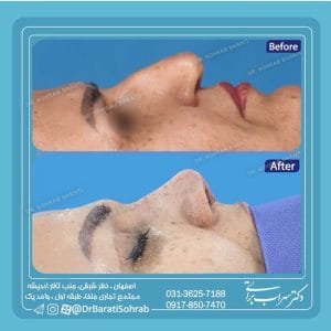 نمونه جراحی از بهترین جراح بینی طبیعی در اصفهان _ دکتر سهراب براتی-drsohrabbarati.com