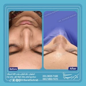 تصویری از نمونه کار بهترین جراح بینی نیمکه فانتزی در اصفهان - دکتر سهراب براتی-drsohrabbarati.com