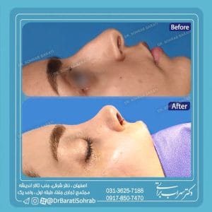 تصویری از نمونه کار بهترین جراح بینی نیمکه فانتزی در اصفهان - دکتر سهراب براتی-drsohrabbarati.com