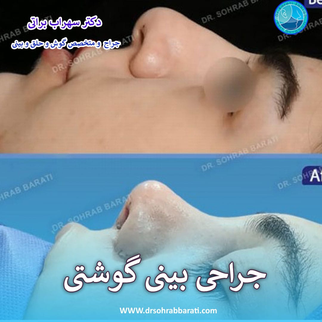 جراحی بینی گوشتی در اصفهان _ دکتر سهراب براتی