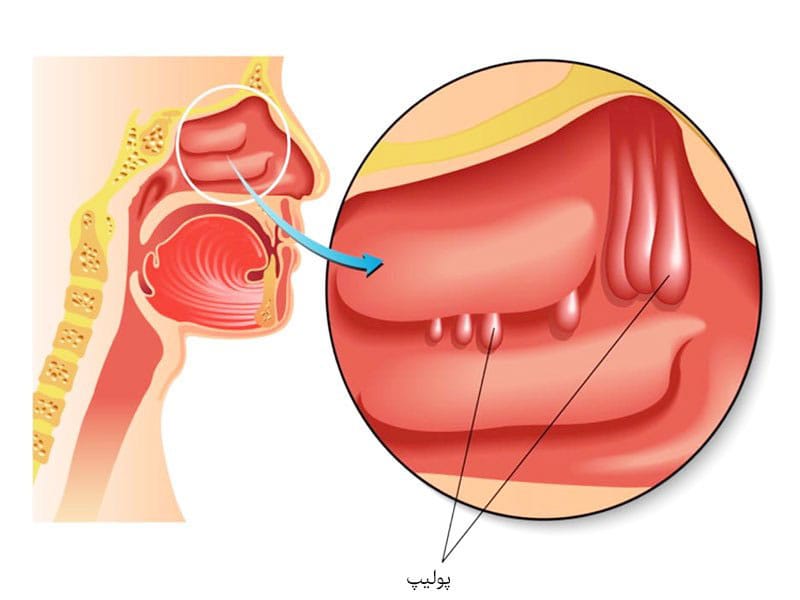 درمان پولیپ بینی در اصفهان _ دکتر سهراب براتی