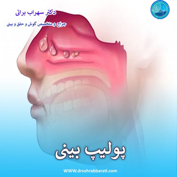 پولیپ بینی - دکتر سهراب براتی