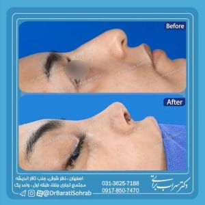 جراحی بینی نیمه فانتزی در اصفهان _ دکتر سهراب براتی 
