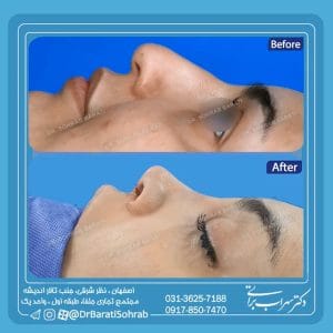 عمل بینی نیمه فانتزی در اصفهان _ دکتر سهراب براتی 