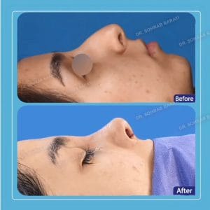 جراحی بینی طبیعی در اصفهان - دکتر سهراب براتی