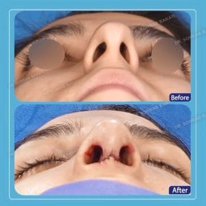 جراحی بینی طبیعی در اصفهان - دکتر سهراب براتی