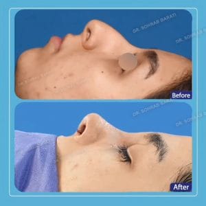 جراحی بینی طبیعی در اصفهان - دکتر سهراب براتی