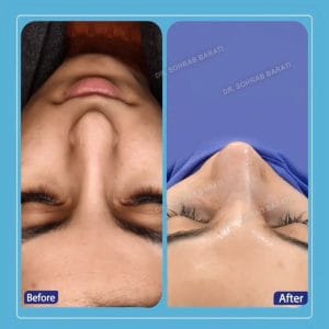 جراحی بینی طبیعی در اصفهان - دکتر سهراب براتی