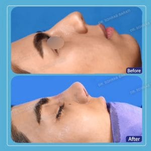 جراحی بینی طبیعی در اصفهان _ دکتر سهراب براتی