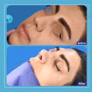 عمل بینی نچرال در اصفهان - دکتر سهراب براتی