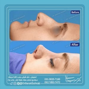 نمونه جراحی بینی در اصفهان - دکتر سهراب براتی