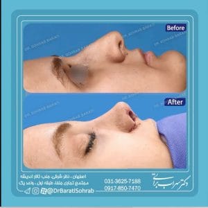 نمونه جراحی بینی در اصفهان - دکتر سهراب براتی