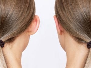قبل و بعد جراحی زیبایی گوش در اصفهان - دکتر سهراب براتی