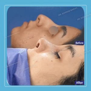 نمونه کار جراحی بینی نیمه عروسکی _ دکتر براتی