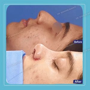 نمونه عمل بینی گوشتی در اصفهان _ دکتر سهراب براتی