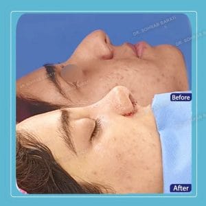 نمونه عمل بینی گوشتی در اصفهان _ دکتر سهراب براتی