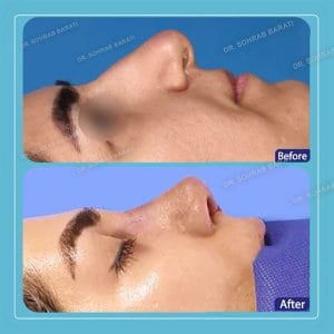 نمونه کار ماساژ بینی بعد از جراحی _ دکتر سهراب براتی-drsohrabbarati.com