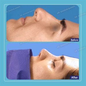 ماساژ بینی بعد از عمل بینی در اصفهان _ دکتر سهراب براتی-drsohrabbarati.com