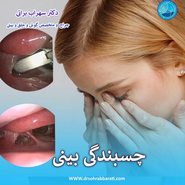 عکس چسبندگی بینی بعد از جراحی _ دکتر سهراب براتی