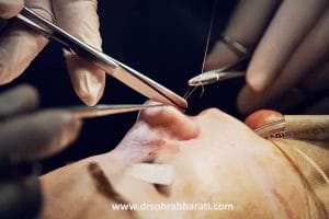 بخیه زدن بینی بعد از عمل _ دکتر سهراب براتی 