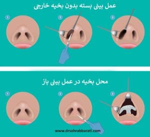 بخیه عمل بینی _ دکتر سهراب براتی