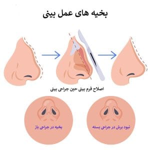 بخیه های عمل بینی _ دکتر سهراب براتی