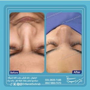 عکس عمل بینی نیمه عروسکی _ دکتر براتی