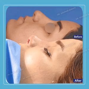 عکس عمل بینی نیمه فانتزی گوشتی _ دکتر سهراب براتی