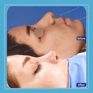 عکس جراحی بینی نیمه فانتزی گوشتی _ دکتر براتی